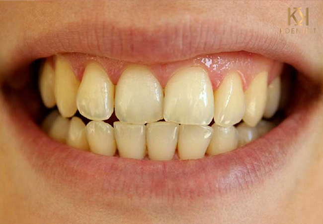 Tình trạng răng bị ố vàng
