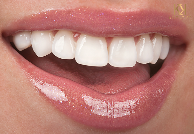 Các ưu điểm của dán răng sứ veneer