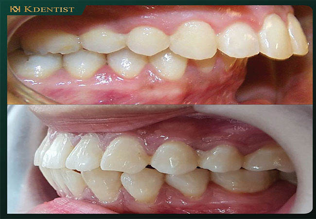 răng bị nặng phải phẩu thuật kết hợp với niềng răng