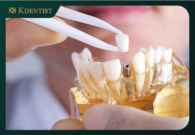 Dịch vụ trồng răng implant ở Quy Nhơn