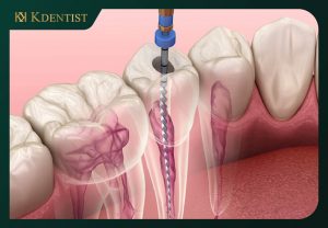 Các yếu tố ảnh hưởng tới chi phí chữa tủy răng