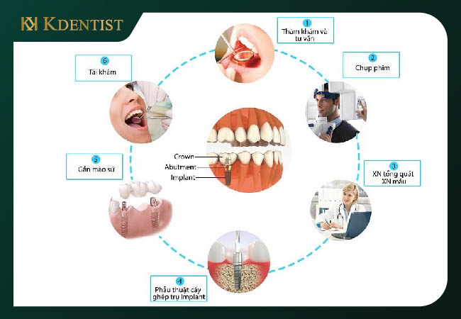 Quy trình trồng răng implant Hàn Quốc