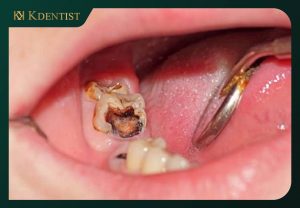 Tình trạng của tủy răng