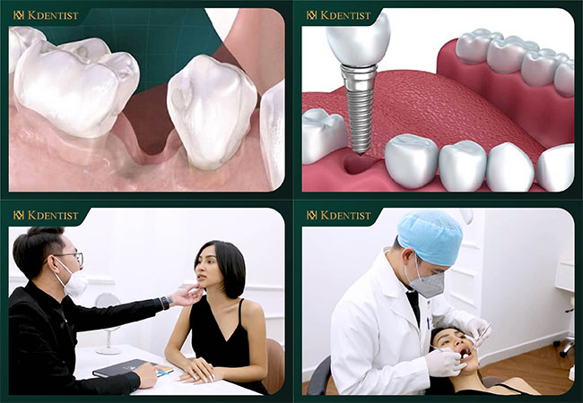 Trồng răng implant ở quảng ngãi