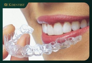 phương pháp niềng răng hiệu quả và tiết kiệm chi phí