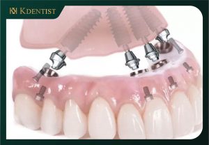 Các phương pháp trồng răng implant toàn hàm
