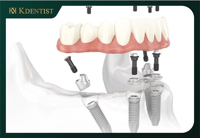 Trồng răng implant toàn hàm all on 4
