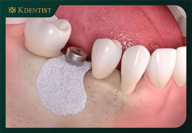 Trụ răng implant cấy trực tiếp vào xương hàm
