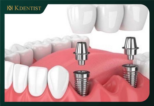 Răng trụ implant Neodent Thụy Sĩ