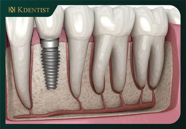 Răng trụ implant Straumann Thụy sỹ