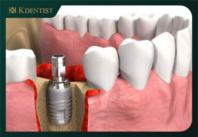 Răng trụ implant Mis C1 Đức