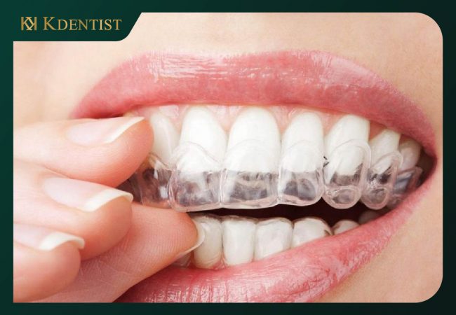 Niềng răng trong suốt (invisalign)