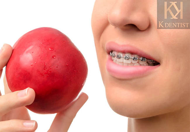 Niềng răng gây Khó khăn trong quá trình ăn uống