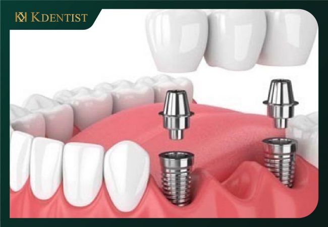 Chất lượng của trụ răng implant