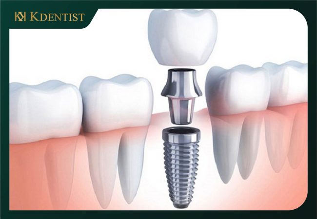 Răng trụ implant Osstem Hàn Quốc