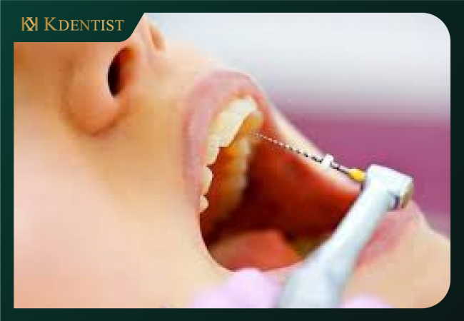 Điều trị chữa tủy răng mất bao lâu thời gian