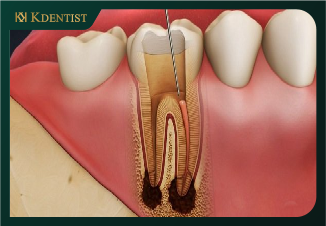 Điều trị tủy răng có nguy hiểm không